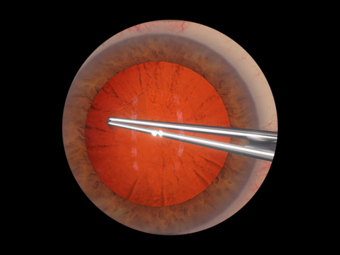 Eyesi Surgical - Cataract surgery